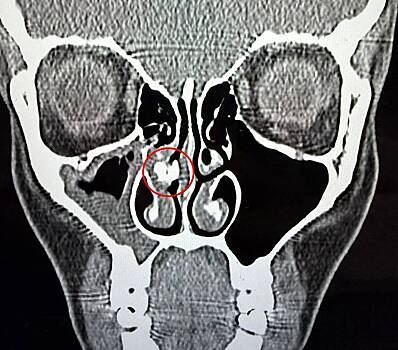 Женщина 35&nbsp;лет прожила с&nbsp;куском скотча в&nbsp;носу